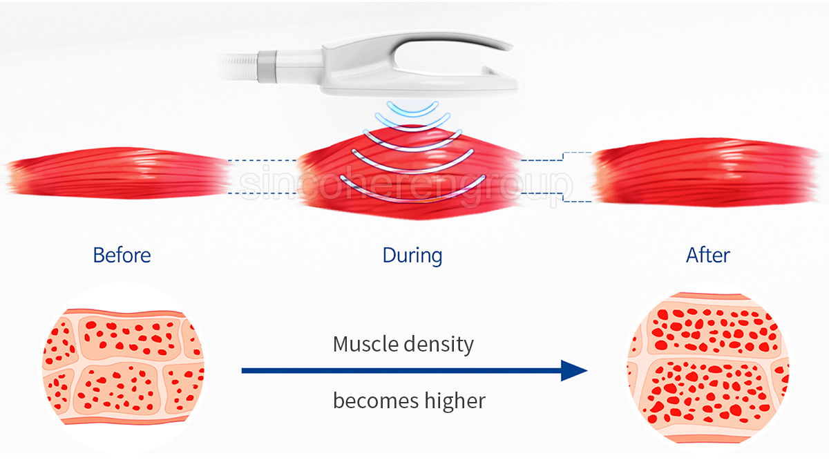 CelluSculpt intensive electromagnetic muscle stimulator