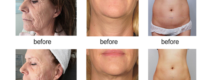 Is HIFU ultrasound machine treatment the future of facelifts
