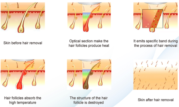 You should do this before undergoing IPL laser hair removal machine treatment