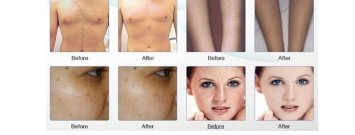 4 skin conditions that you can treat with a laser treatment machine