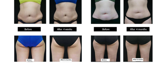 How long does the result of a professional cryolipolysis machine last