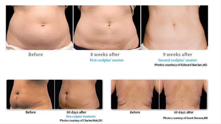 Is CoolSculpting the best body contouring machine treatment