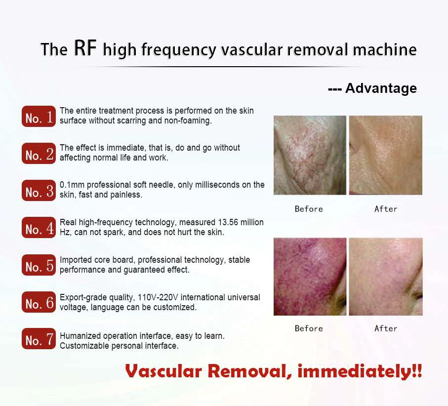 Portable Vascular Vein Removal 980nm Machine