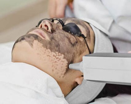 Hollywood facial with ND YAG laser