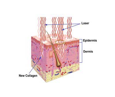 Photon Rejuvenation Solves Your Skin Problems