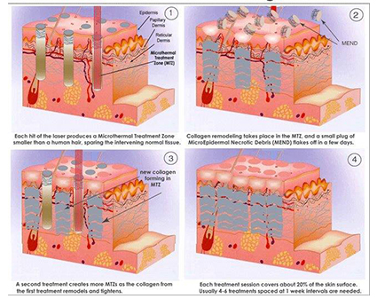 Advantages and Precautions of Laser Scar Removal